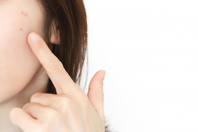 ホルモンとニキビの関係